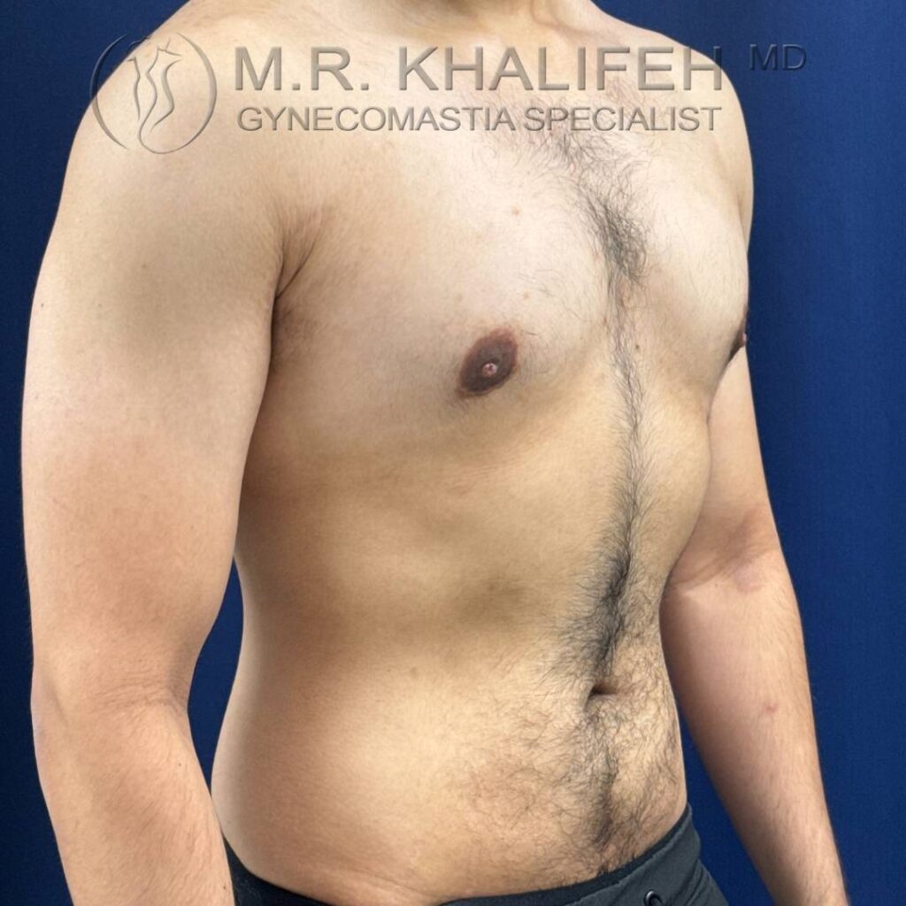 8 Gynecomastia – Right ¾ View After – 2025 10 01.jpg