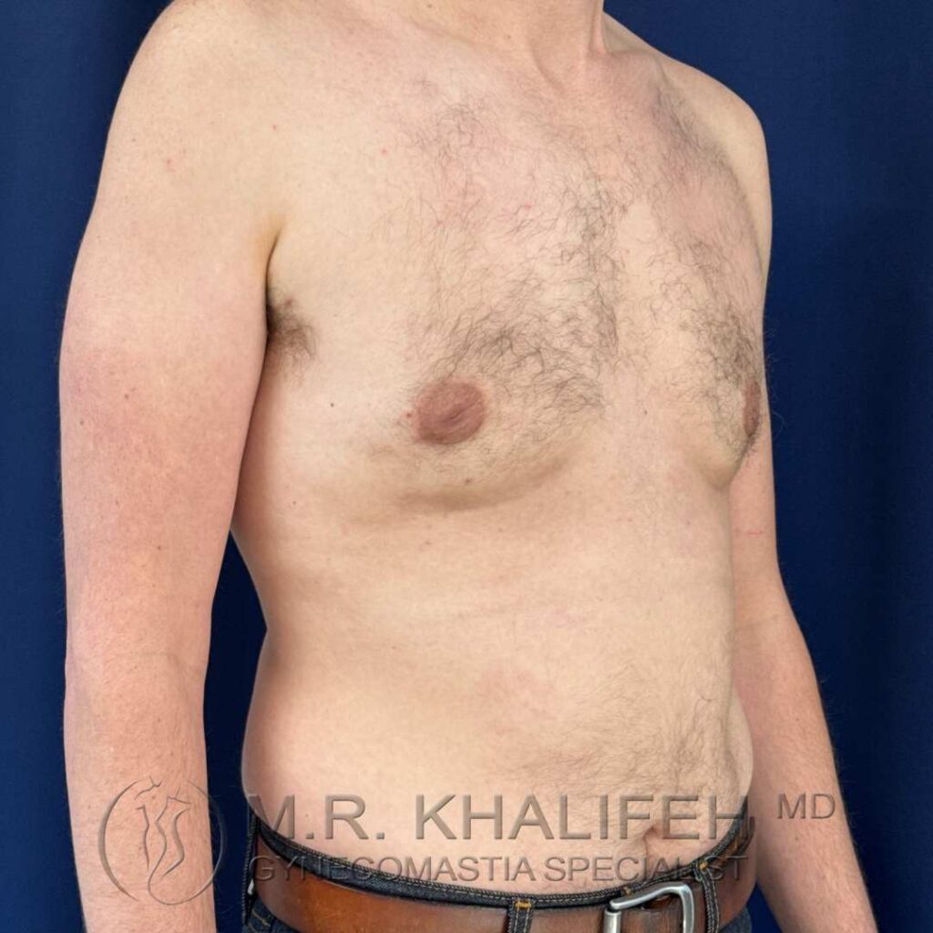 8 after gynecomastia right quarter side 18 12 2025.jpg
