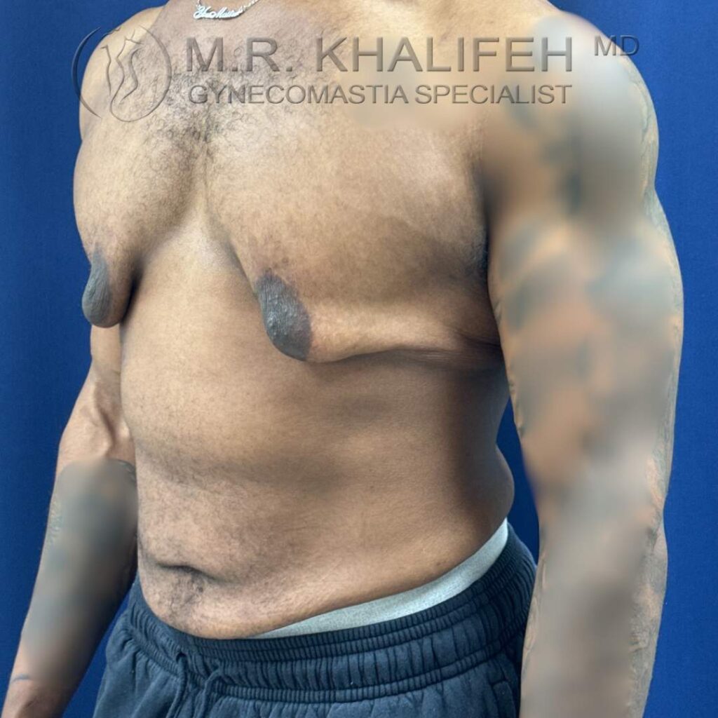9 Before Gynecomastia Surgery – Half Side View Right – 25 Nov 2025.jpg
