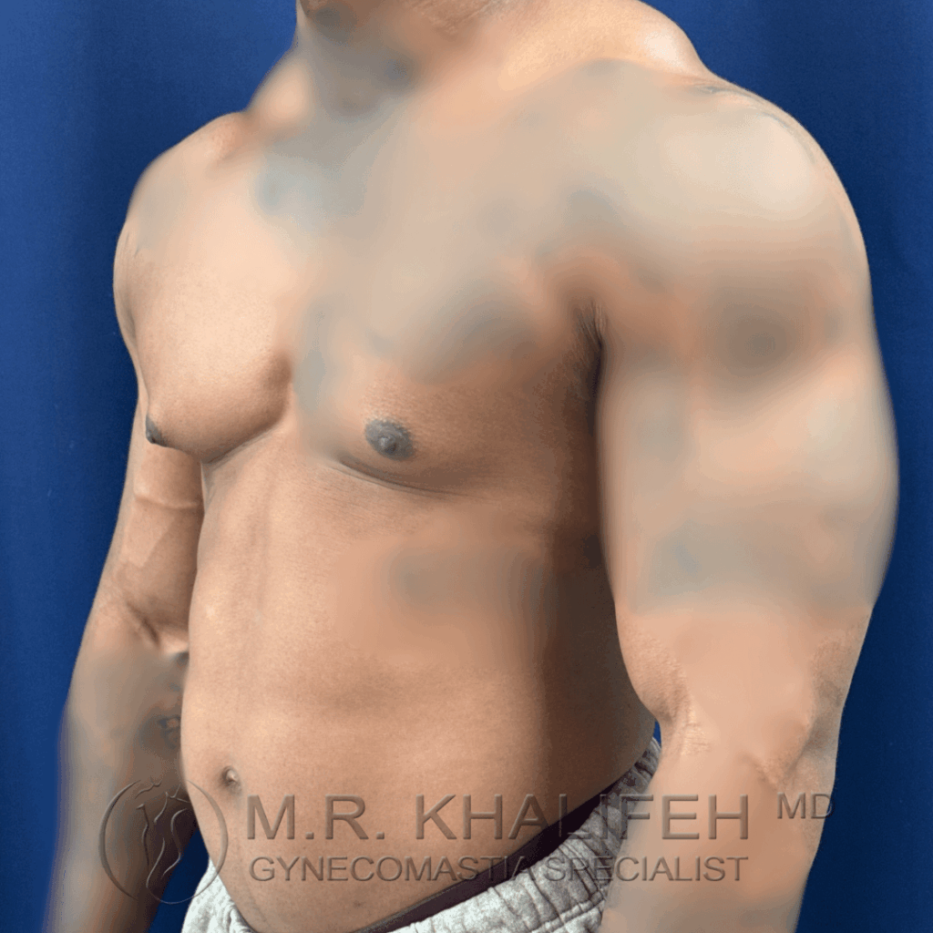 9 Gynecomastia surgery – pre op – 2026 01 28 – left oblique view.png