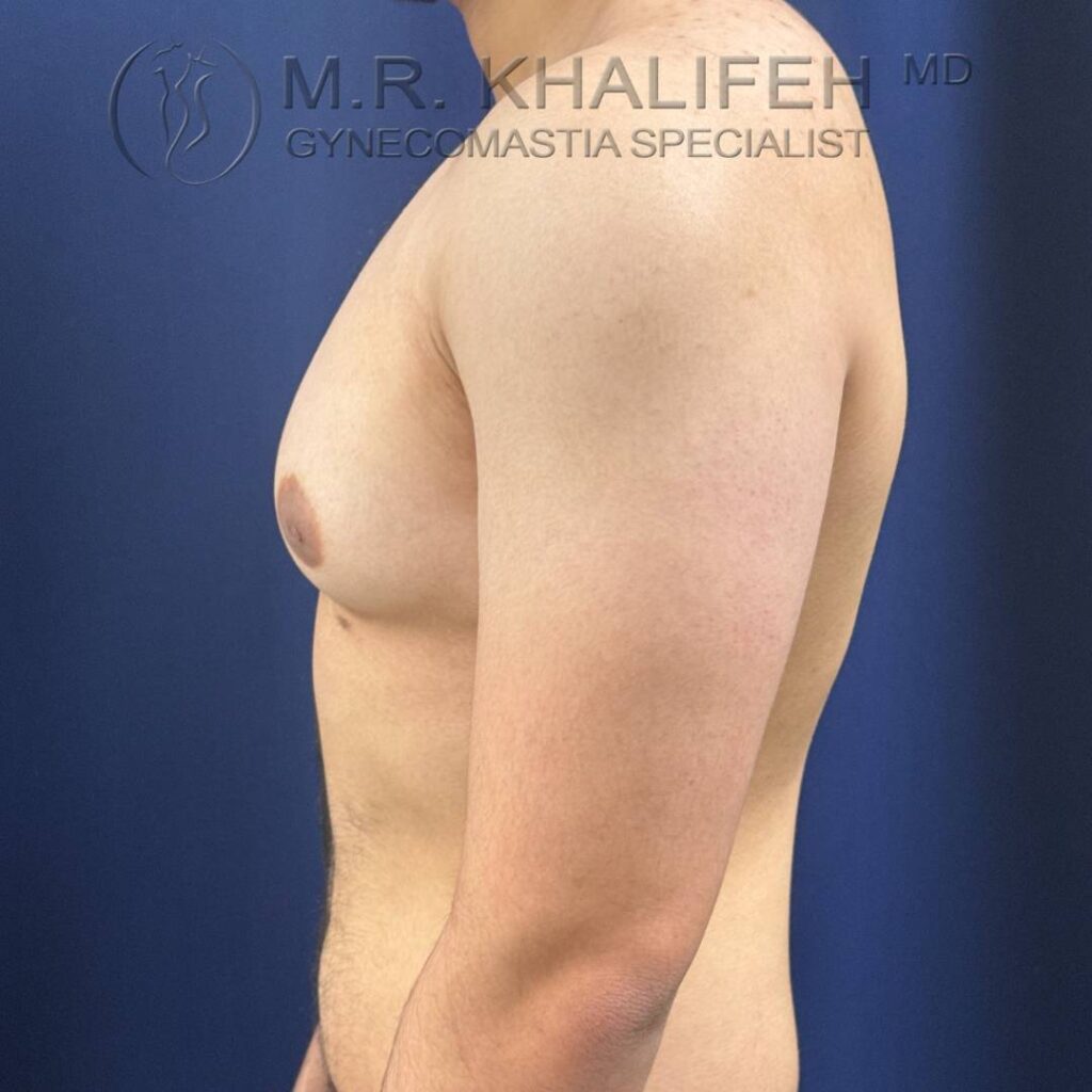 9 Gynecomastia – Left Side Before – 2025 10 01.jpg