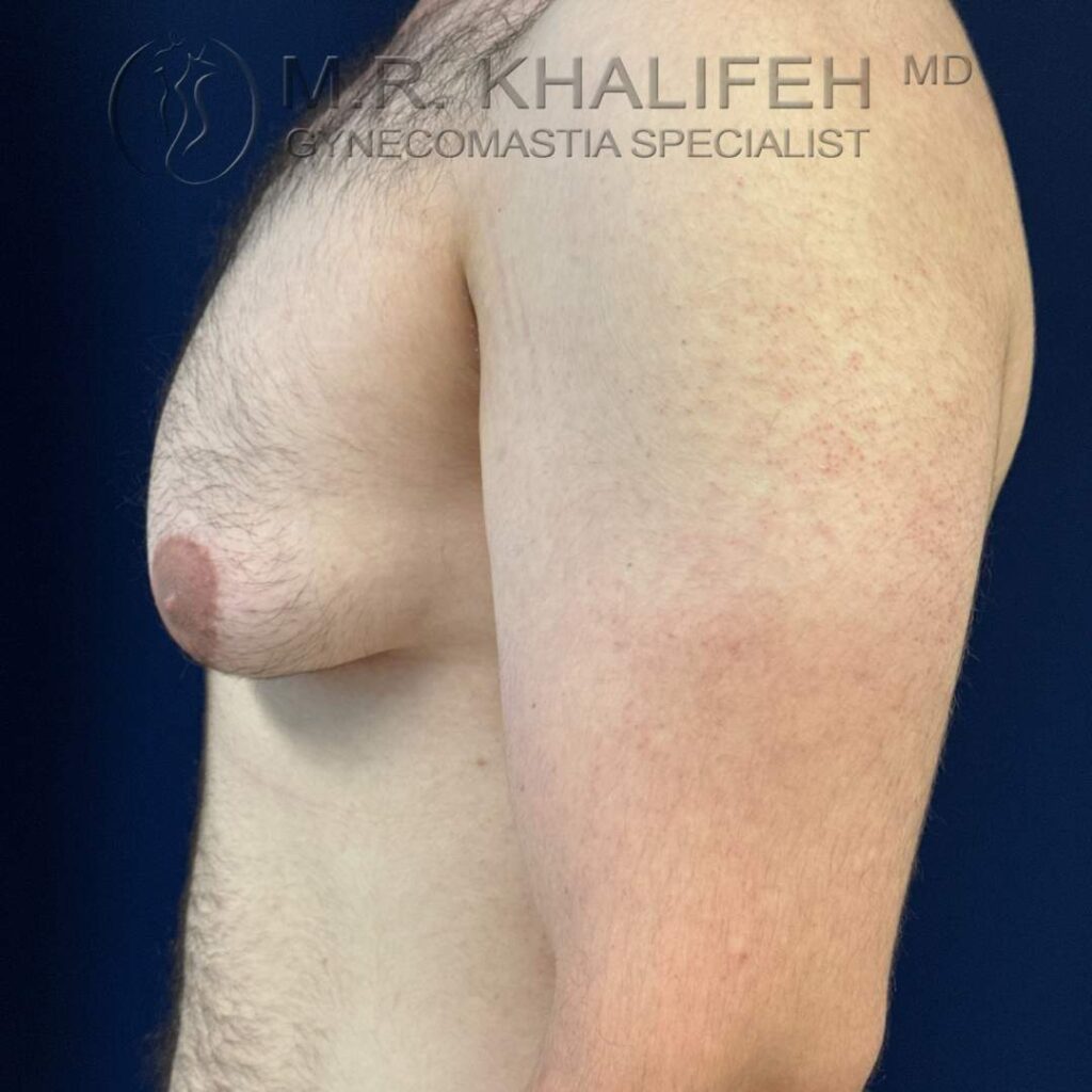 9 before side left with skin excess.jpg
