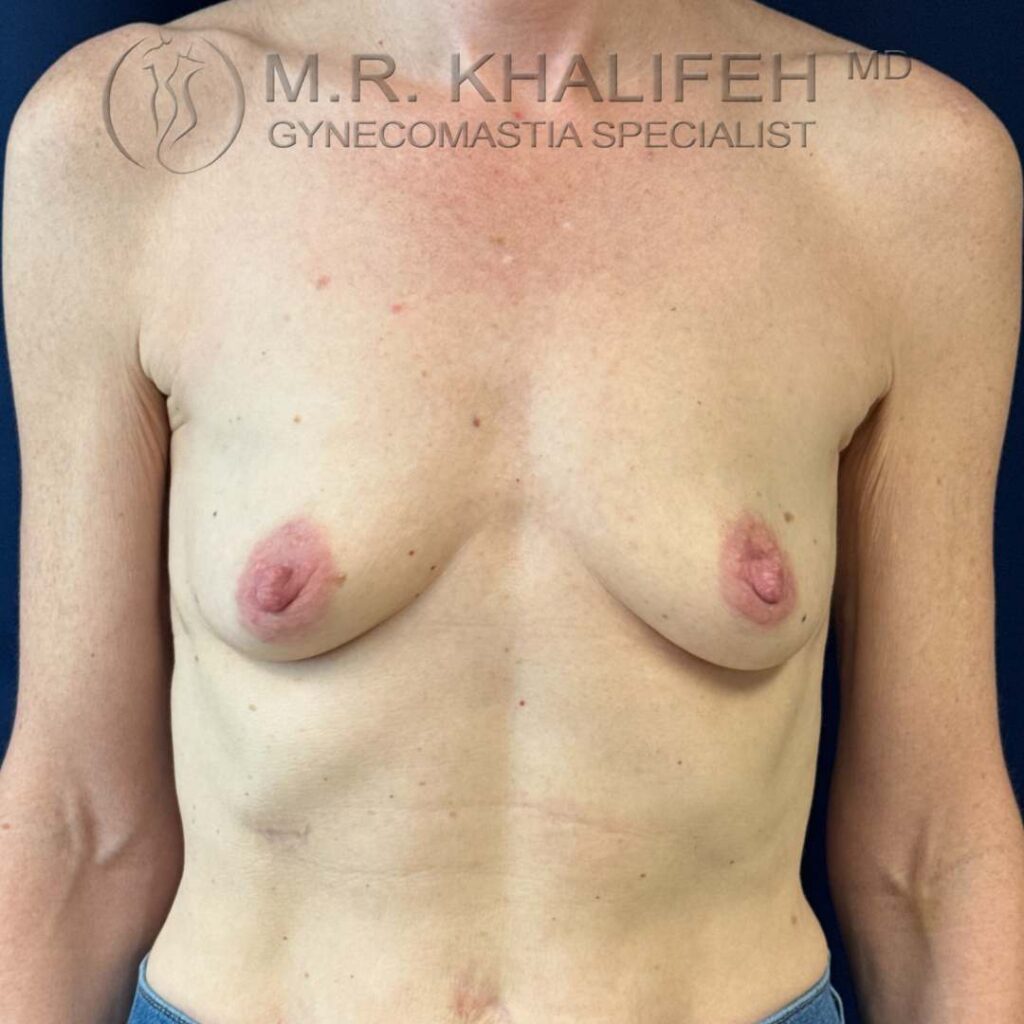 9 breast augmentation side front before.jpg