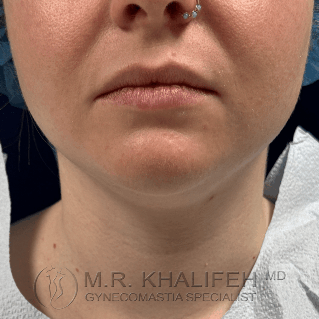 Before front view chinneck liposuction.png