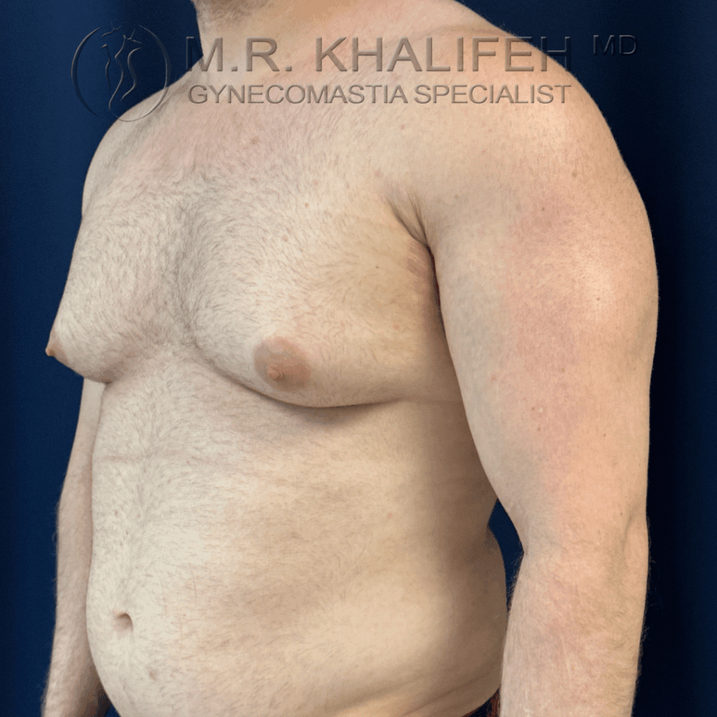 Before half side view left.png