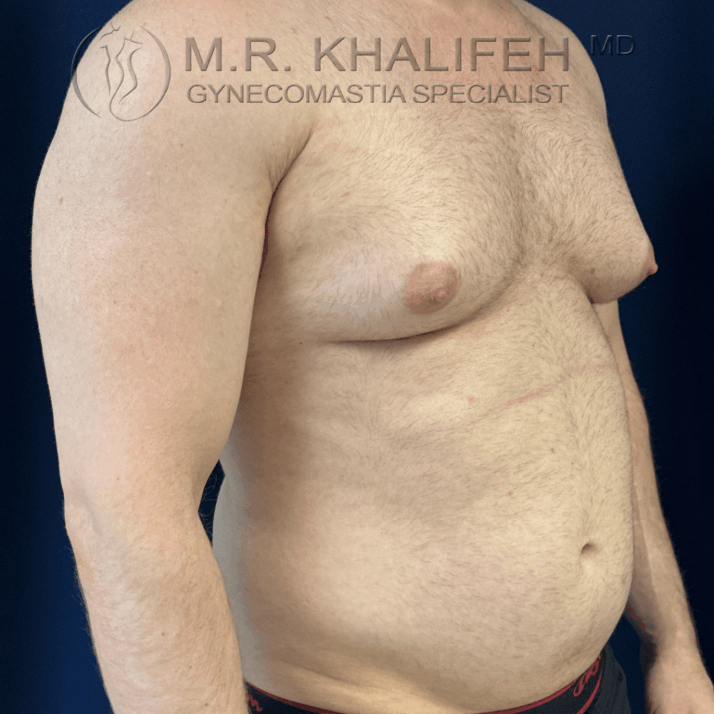 Before half side view right.png