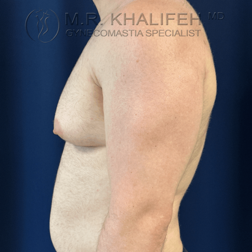 Before side view left.png