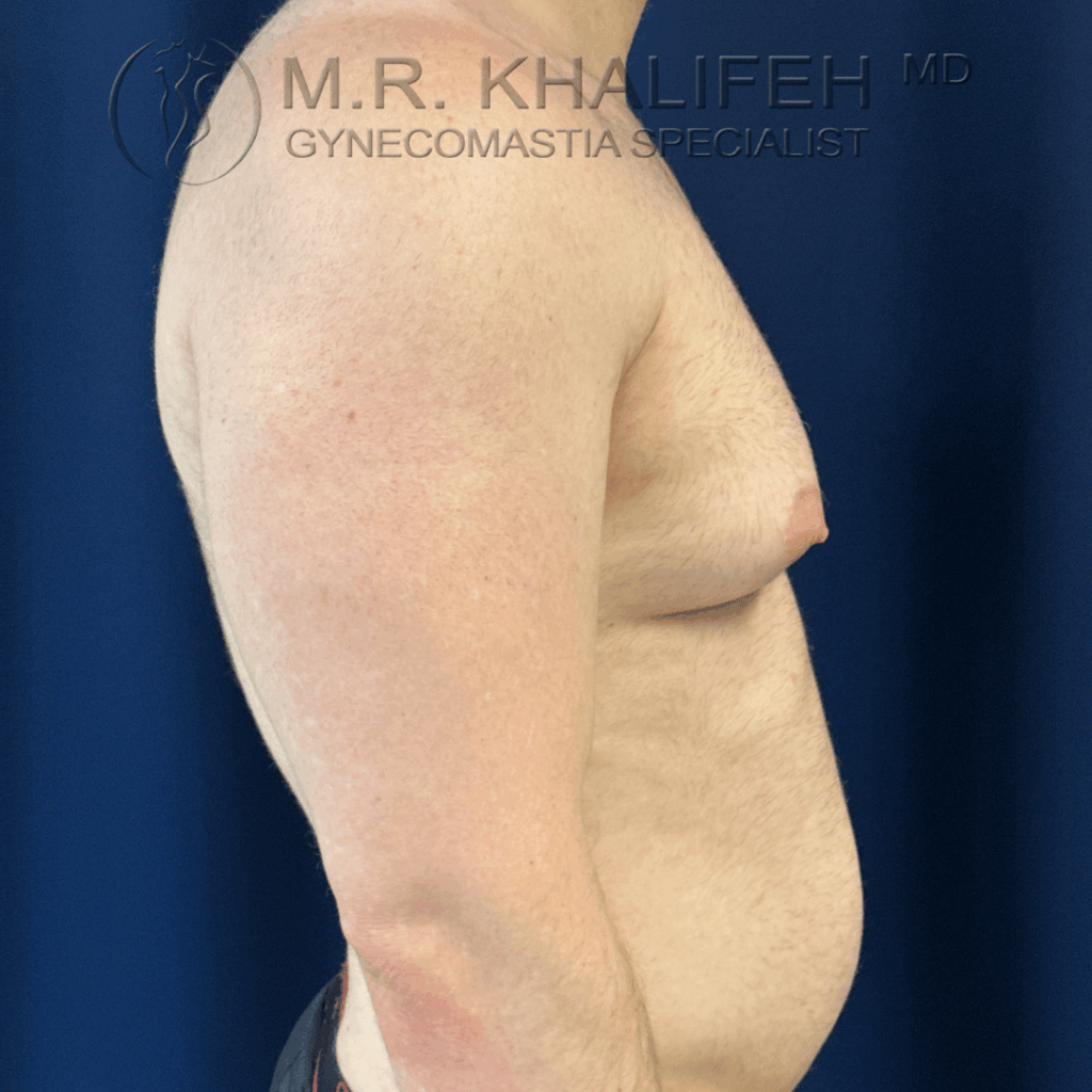 Before side view right.png