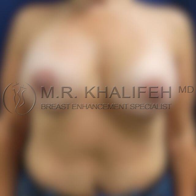 Breast revision after