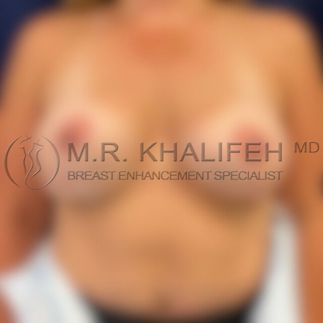 Breast revision before