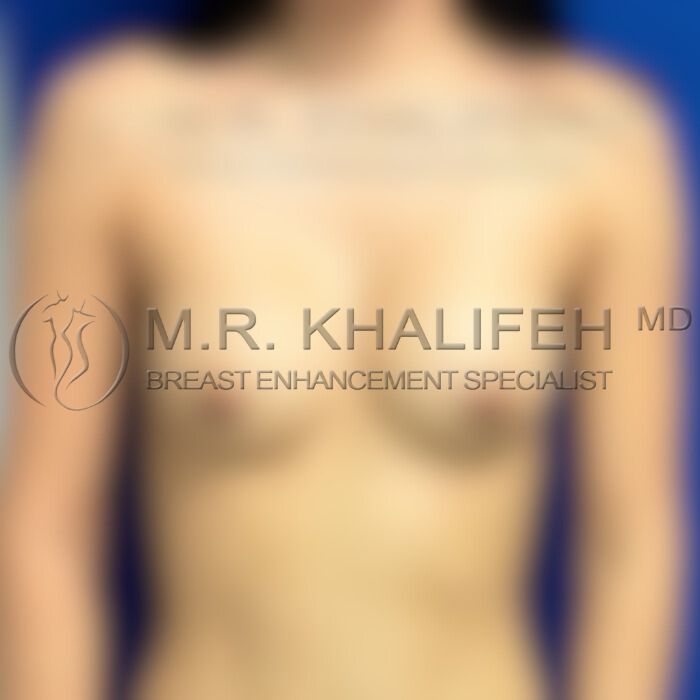 Implant after