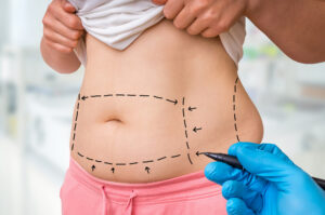 Doctor marking a patient's stomach with a black pen for plastic surgery, liposuction, or abdominoplasty.